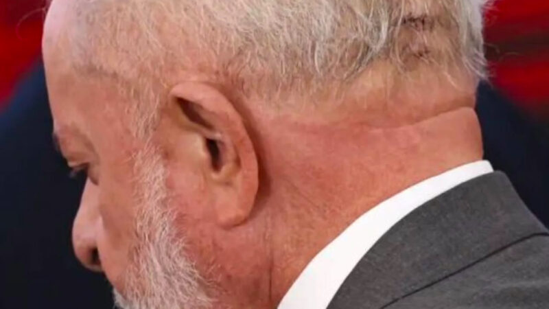 Lula tem dreno intracraniano removido e apresenta evolução estável após procedimentos médicos