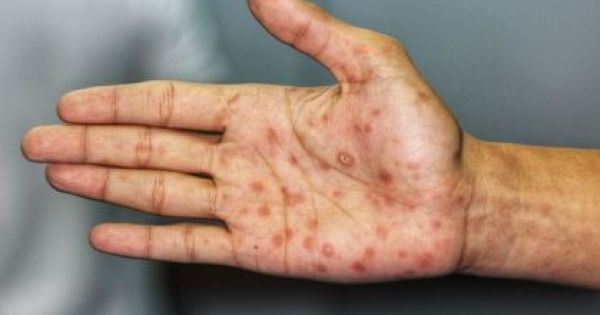 Alerta: Casos de sífilis disparam no Brasil atingindo níveis alarmantes